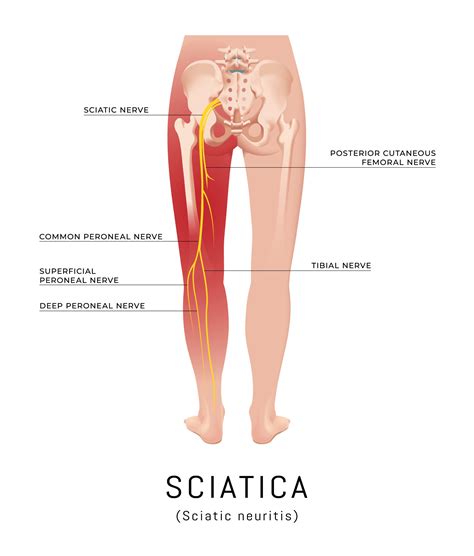 Home Remedies for Sciatica - Colorado Pain Care