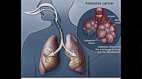 Asbestos Lung Cancer - YouTube