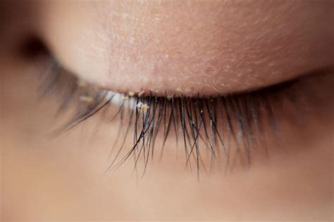 Eyelash Mites: Signs, Causes, and Treatments | MyVision.org