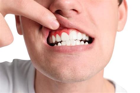 Top Causes of Gum Recession: Tompkins Dental: General Dentistry