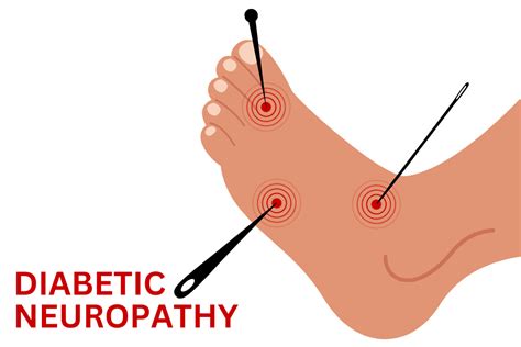 What Are the Different Types of Diabetic Neuropathy? - ENCORE Research ...