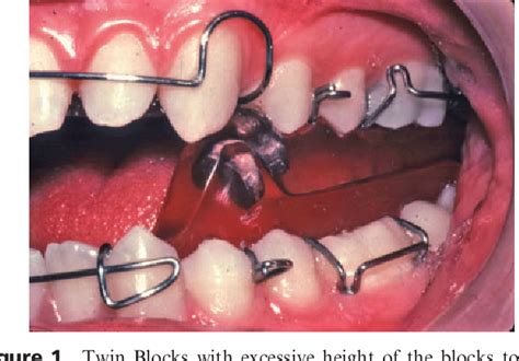 Design and Management of Twin Blocks: Reflections after 30 years of Clinical Use | Semantic Scholar