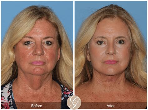 Deep Plane Facelift & Deep Plane Necklift Case 2 Before After Photos Orange County