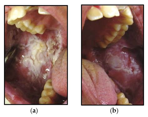 White Sponge Nevus Gingiva