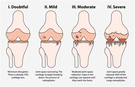 Osteoarthritis - pt Health