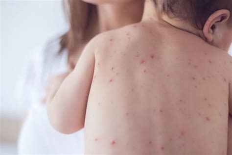 Symptoms, Prevention, and Treatment for Chickenpox… | Pediatrics Of ...