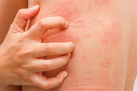 What is an Amoxicillin Rash? | LifeMD