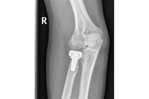 Radial Head Replacement Surgery | Mr Soong Chua