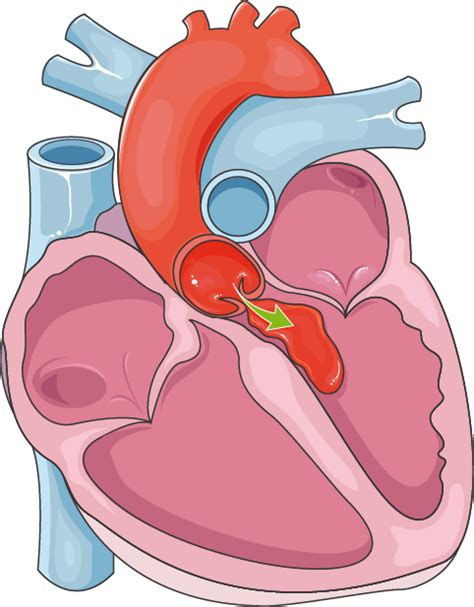 Aortic valve regurgitation - Servier Medical Art