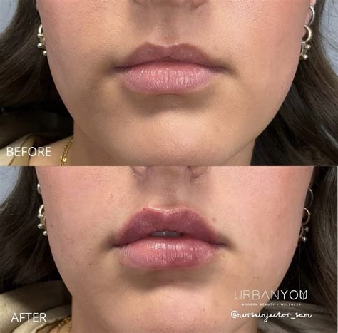 How to get a Lip Flip with Botox: Before and After — Urban You - Modern ...