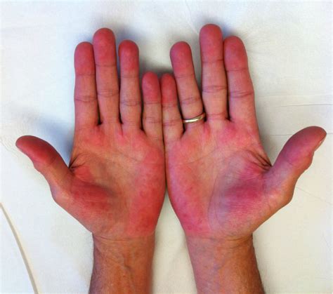 Palmar erythema – Cirrhosis Care