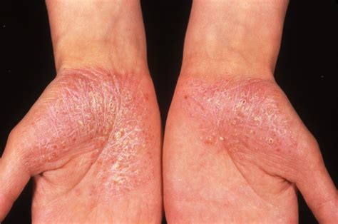 Recognizing and Managing Flares in Generalized Pustular Psoriasis