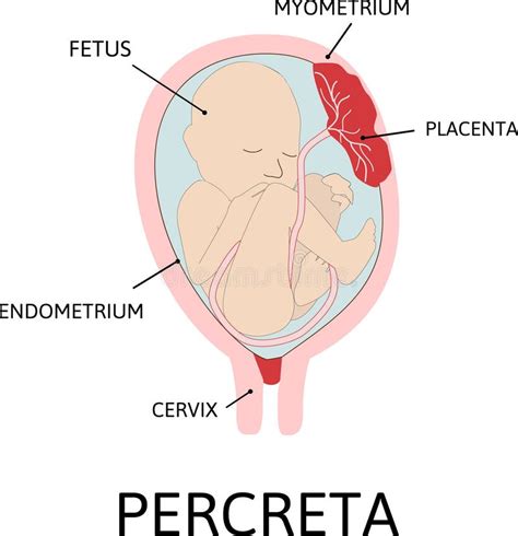 Placenta Accreta. Grades of Abnormal Attachment Illustrated According ...