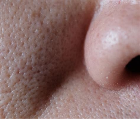 Enlarged And Open Pores - The Ogee Clinic