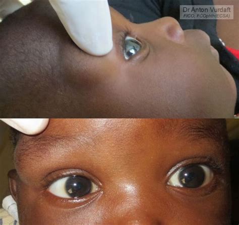 Yet another periorbital dermoid cyst – Tropical Ophthalmology