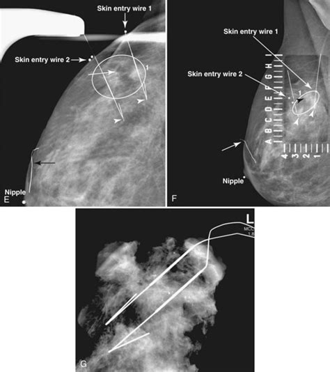 Mammographic and Ultrasound-Guided Breast Biopsy Procedures | Radiology Key