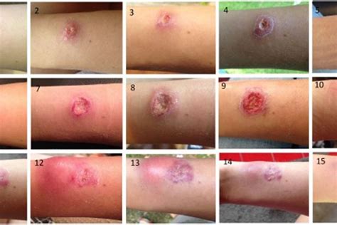 Leishmaniasis Images - vrogue.co