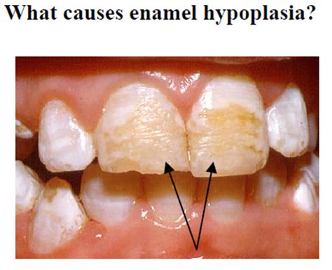 kRes8-Enamel Hypoplasia - dentist Appleton WI - Dental Haven - Dr Gonzalo and Dr Alexandra Hernandez