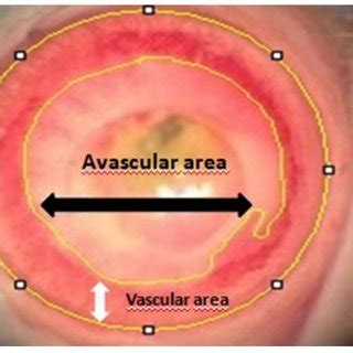 Vascular and avascular corneal area are outlined with reference to the ...