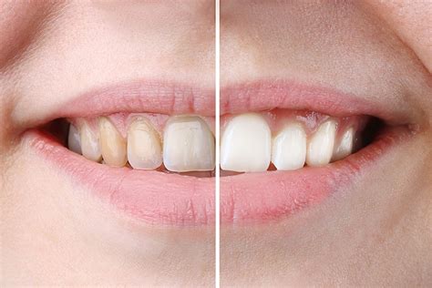 Professional Teeth Whitening vs At Home Solutions | EVDP