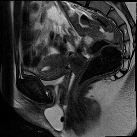 Ureterocele | Radiology Reference Article | Radiopaedia.org