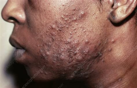 Pustular Acne - Stock Image - C021/9657 - Science Photo Library