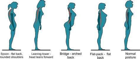 The British Chiropractic Association says posture determines whether you'll get back pain ...