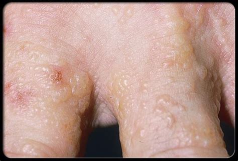 Dyshidrotic eczema (dyshidrotic dermatitis) is an irritation of the ...