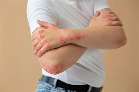 Understanding staphylococcal scalded skin syndrome: Common symptoms and ...