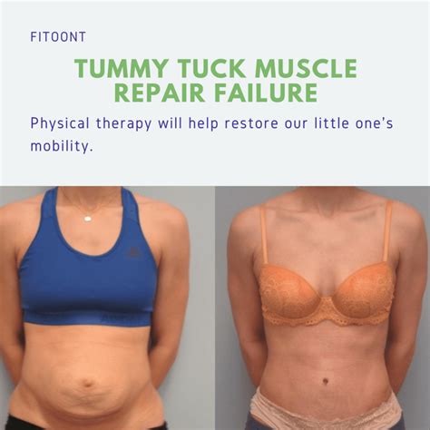 How To Fix Tummy Tuck Muscle Repair Failure? - Fitoont