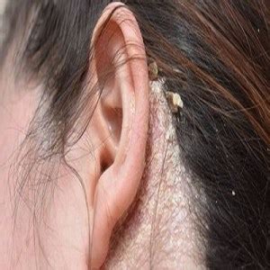 Eczema on Ear - How to Get Rid of Itchy or Dry Ear Eczema?