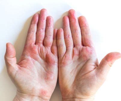 Dyshidrotic Eczema Small Bumps On Hands: Causes, Treatments, Symptoms | DrugsBank