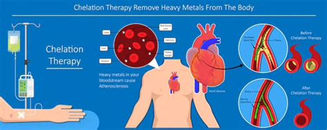 Heavy Metal Chelation Therapy Gladstone - Vitality Solutions