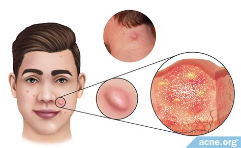 Skin Nodule Acne