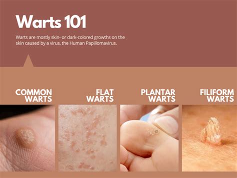 Laser Wart Removal Singapore - Edwin Lim Medical Aesthetic Clinic