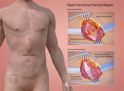 Incisional Hernia Repair near Pasadena and Los Angeles CA