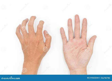 Hand Muscle Spasm In Asian Young Man. Unilateral Hand Deformity. Abnormal Fingers Flexion Stock ...