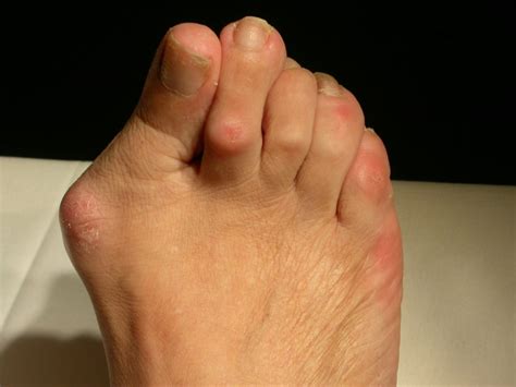 Bunion Surgery - The Foot and Ankle Clinic