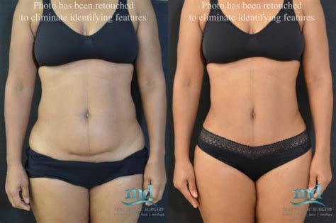 Mini Tummy Tuck Before & After Photo Gallery | Melbourne, FL | Michael ...