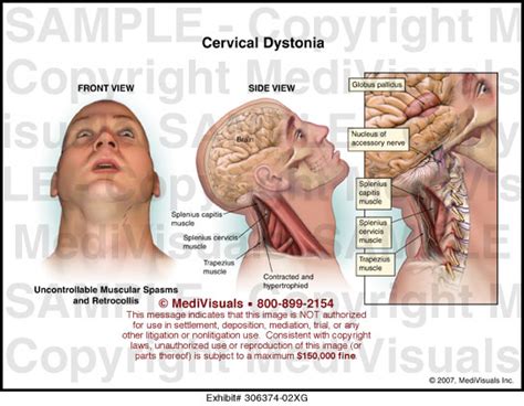 Cervical Dystonia Medical Illustration Medivisuals