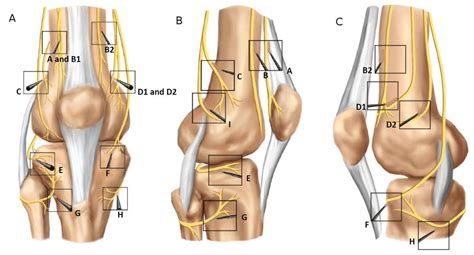 Technical Considerations for Genicular Nerve Radiofrequency Ablation ...