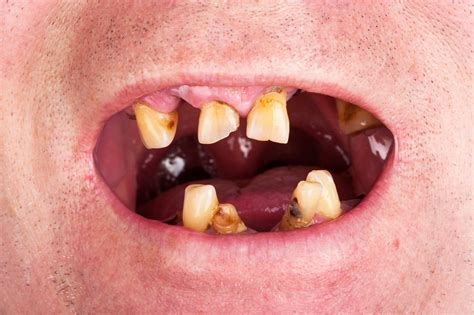 Oral Cancer and Chewing Tobacco