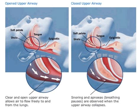 How To Get Rid Of Snoring Problem Once And For All