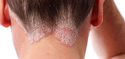 PSORIASIS - Diagnosis and treatment - CubaHeal