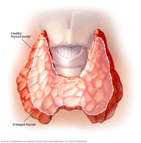 Goiter - Symptoms and causes - Mayo Clinic