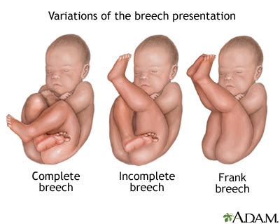 Knee Breech Presentation