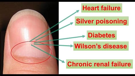 BIOLOGY BEHIND HALF-MOON SHAPE ON OUR FINGERNAILS|| WHITE/BLACK/YELLOW ...