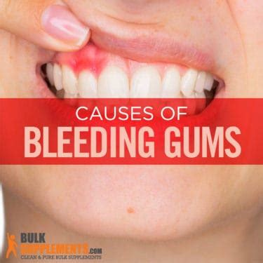 Bleeding Gums: Characteristics, Causes & Treatment