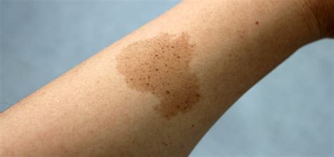 Birthmarks | Dermatology and Skin Health - Dr. Mendese