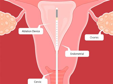 Endometrial Ablation: Insights into Procedure, Recovery, and Considera – EZNurse